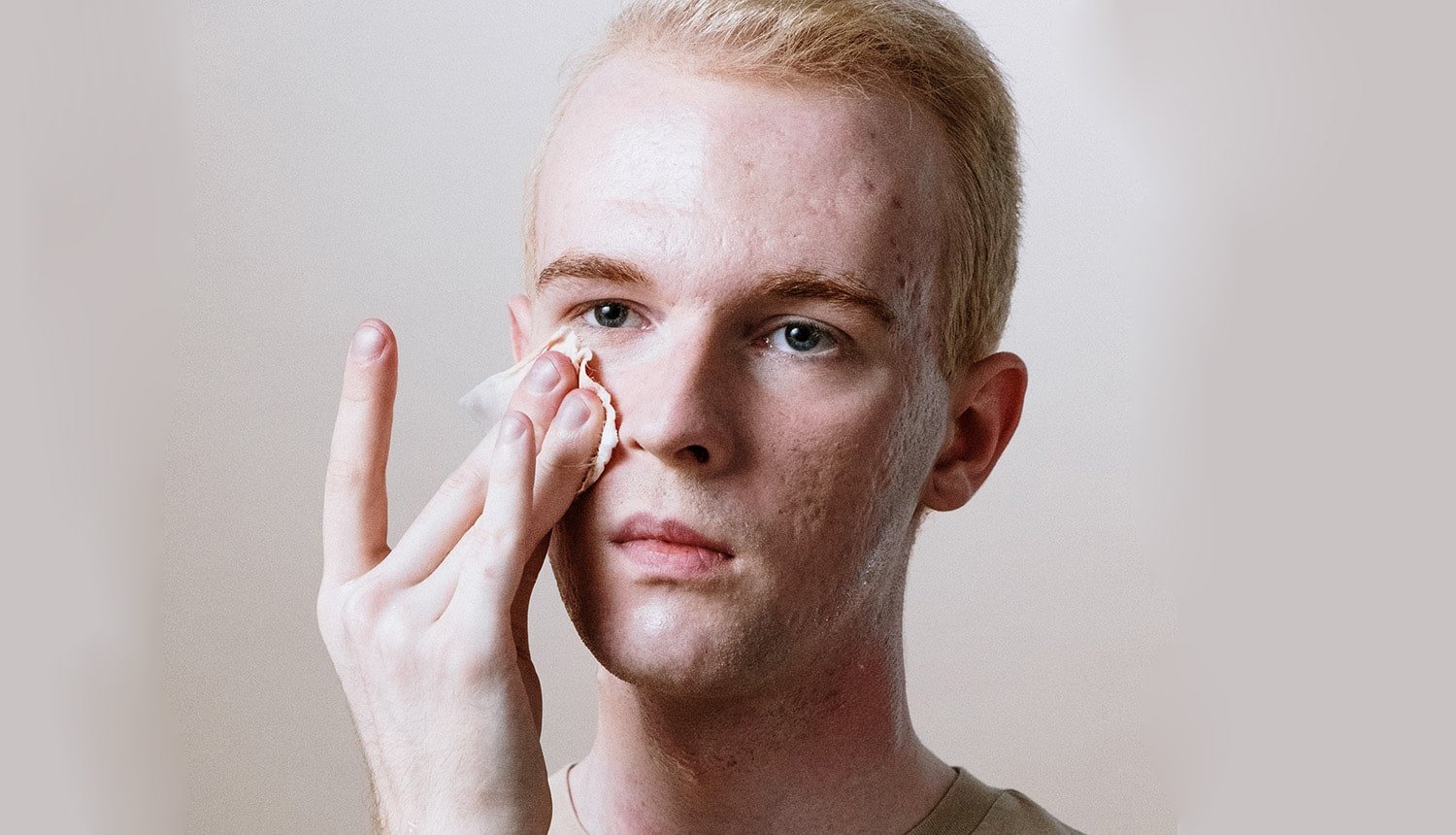 Cravos, espinhas e oleosidade: como cuidar da pele com acne - Dr. JONES